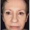 Blépharoplastie inférieure