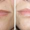 Lip augmentation - cheiloplasty
