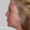 Facelift, SMAS Facelift