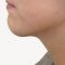 Ultrasonic liposuction