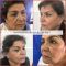 Cirugía de párpados (Blefaroplastia)