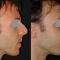 Rhinoplastie