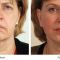 Facelift - 3D kanylové nitě