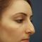 Rhinoplasty (Nose Job)