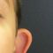 Otoplastie (Chirurgie esthétique des oreilles)