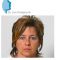 Lipofilling ou autogreffe de tissu graisseux