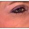 Botulinum toxin - Wrinkle Removal