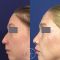 Plastika nosu (Rhinoplastika)