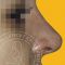 Plastika nosu (Rhinoplastika)
