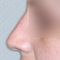 Plastika nosu (Rhinoplastika)