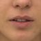 Lip Lift