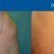 Gynecomastia (Male Breast Reduction)