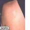 Rimozione tatuaggi - laser