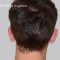 Ear surgery (Otoplasty)