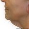 Facelift