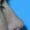 Plastika nosu (Rhinoplastika)