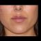 Hyaluronic acid-based wrinkle fillers