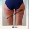Eliminación no invasiva de grasa y celulitis – Lipoescultura