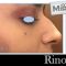 Rinoplastica non chirurgica
