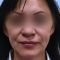 Facelift, SMAS facelifting