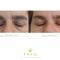 Operácia očných viečok (Blepharoplastika)