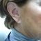 Otoplastie (Chirurgie esthétique des oreilles)