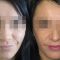 Profiloplastyka twarzy (implantaty)