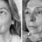 Lifting Facial Silhouette Soft