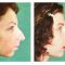 Chin Surgery