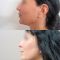 Facelift, SMAS facelifting
