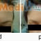 Botulinum toxin - Wrinkle Removal