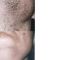 Depilazione laser