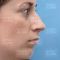 Operácia nosa (Rhinoplastika)