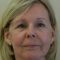 Facelift, SMAS Facelift