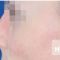 Nasenkorrektur - Rhinoplastik