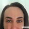 Nichtchirurgische Faltenbehandlung - BOTOX® / DYSPORT®
