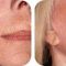 Fotorejuvenizácia /Resurfacing