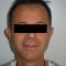 Otoplastie (Chirurgie esthétique des oreilles)