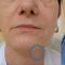 Facelift, SMAS facelifting
