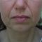 Facelift, SMAS facelifting