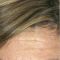 BOTOX®