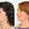Facelift