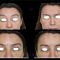 Hyperhidrose traitement (transpiration excessive) - Botox