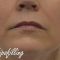 Lipofilling, Lipotransfer (aplikácie vlastného tuku)