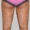 Liposuction