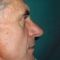 Rhinoplasty (Nose Job)