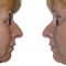 Facelift, SMAS facelifting