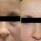 Kwas hialuronowy: Saypha, Restylane, Juvederm, Stylage