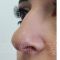 Non-Surgical Nose Job