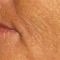 Fotorejuvenace / Resurfacing